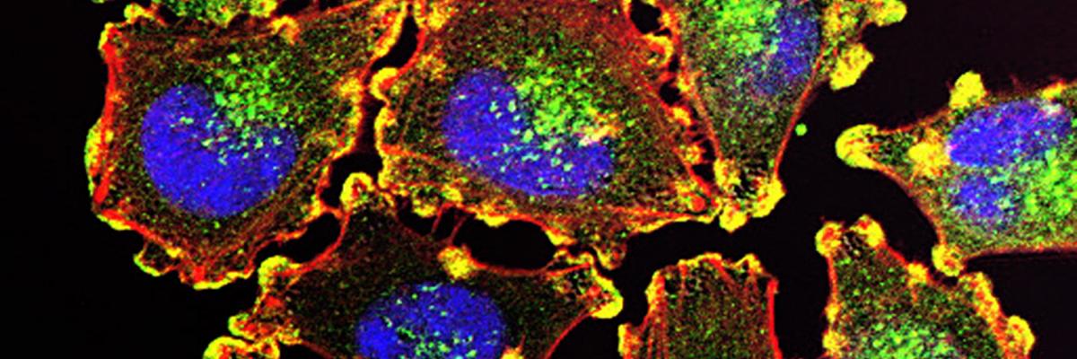 Metastatic melanoma cells